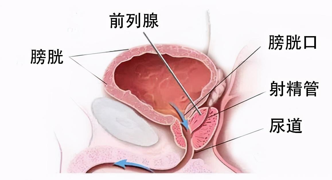 前列腺炎好治吗要多久