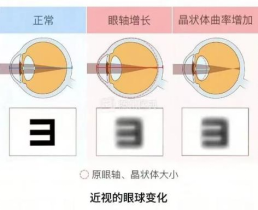 眼涩眼干视力模糊怎么回事