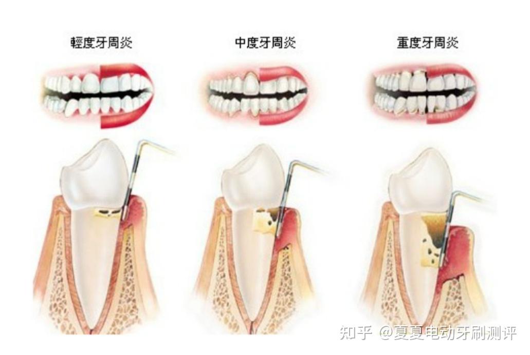 牙周炎图片及症状图片