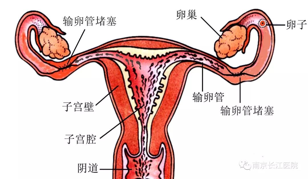 子宫肌瘤最怕三个运动尿道放了双丿管为什么就尿pieng