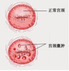 宫颈纳氏囊肿什么意思,宫颈纳氏囊肿的解析与灵活设计网页版应用探索,全面设计执行方案_版部72.71.81