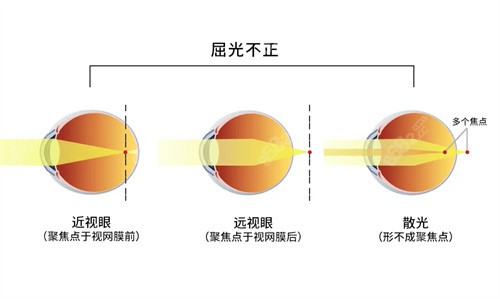 近视眼晶体植入可以管多少年