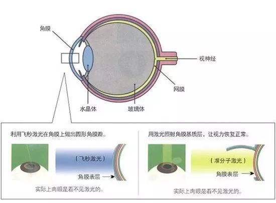 准激光和飞秒激光哪个好