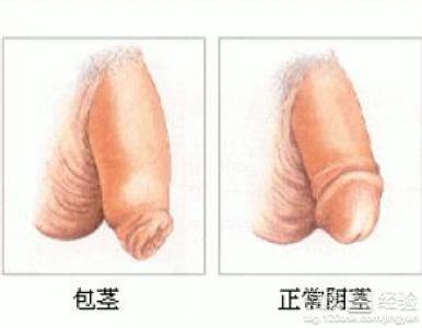 包皮过长手术图片视频