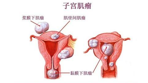 中医怎么治疗子宫肌瘤